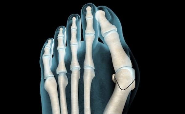 Halluks Valgus ve Tedavisi