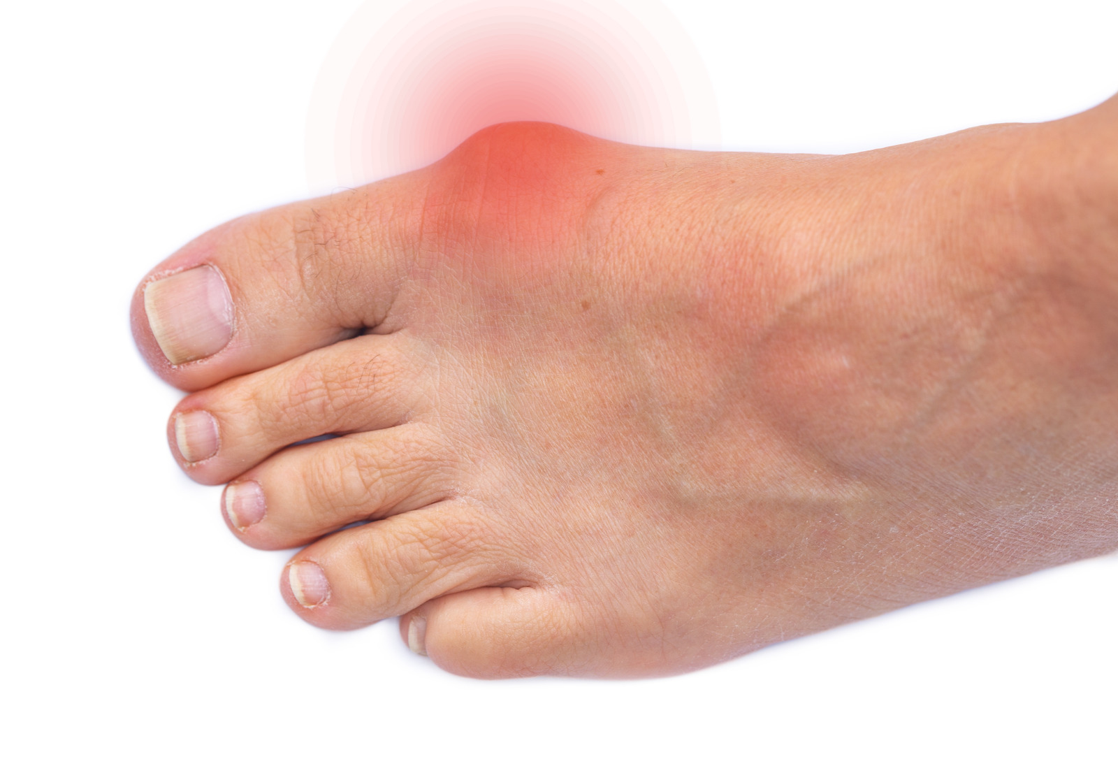 Halluks Valgus